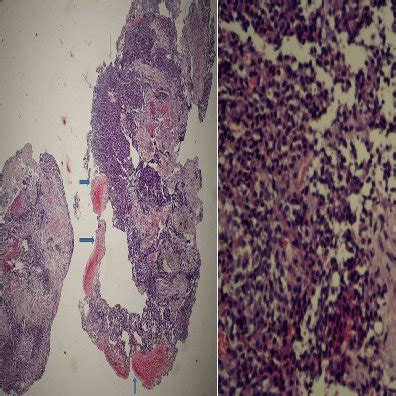 A Hyperplasia Of Tongue Mucosal Squamous Epithelium In Rats Of The