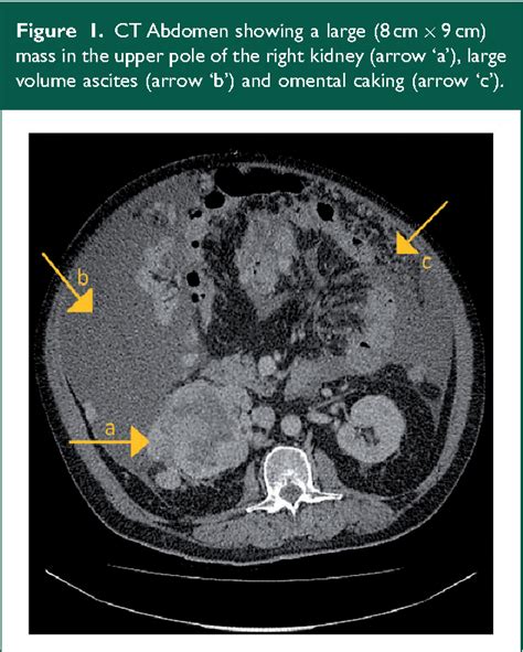 Figure 1 From Renal Cell Carcinoma Presenting With Malignant Ascites