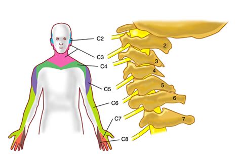 Cervical Radiculopathy: Hand and Arm Pain