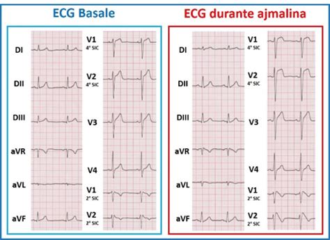 Sindrome Di Brugada Spesso La Diagnosi E Tardiva Studio