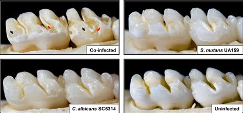 Images Of Teeth From Rats Infected With S Mutans Ua159 Andor C