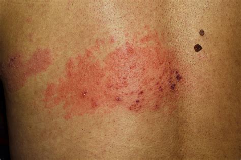 Shingles Rash On Neck