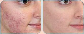 Dermal Abrasion Skin Treatment at best price in Delhi | ID: 8894185362