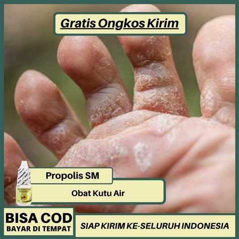 Obat Kutu Air Di Telapak Kaki Homecare24