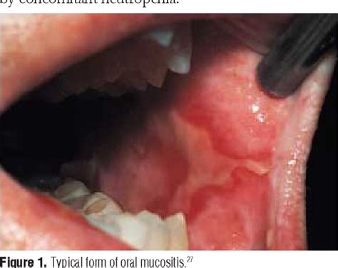 Figure 1 From Cancer Therapy Induced Oral Mucositis A Review Of Epidemiology Patophysiology