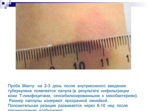 Папула манту как выглядит фото