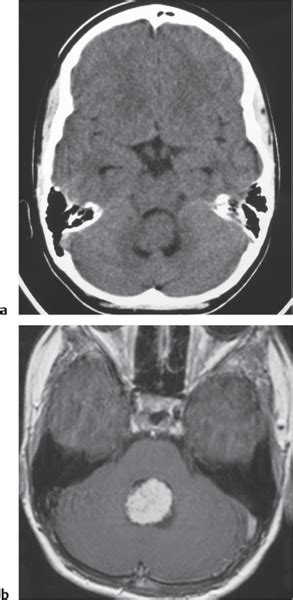 I Intracranial Lesions Radiology Key