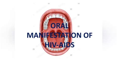 Oral Manifestation Of Hiv Aids Youtube