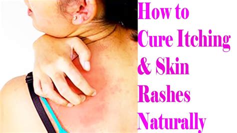 3 Most Effective And Easy Home Remedies For Itchy Skin How To Cure Itching And Skin Rashes