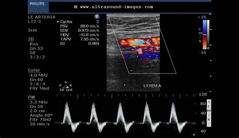 cochinblogs: Popliteal vein thrombosis- on arterial Doppler study