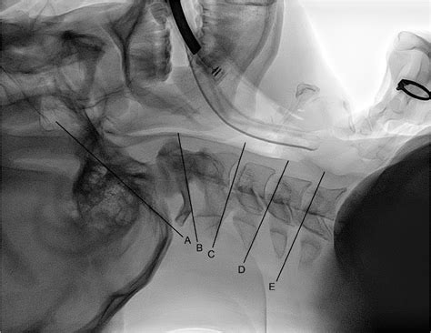 Figure 1 From Effects Of External Laryngeal Manipulation On Cervical