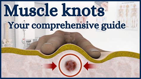 Muscle Knots Your Comprehensive Guide Youtube