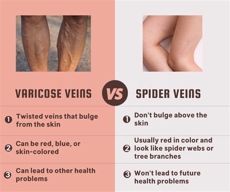 Varicose Veins Versus Spider Veins Mimit Health