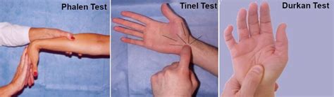 Carpal Tunnel Syndrome Symptoms