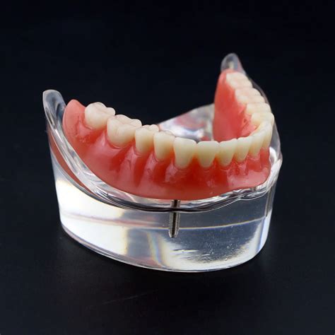 Dental Overdenture Inferior With 2 Implants Demo Model Study Model