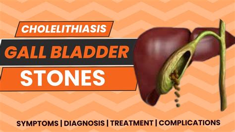 Cholelithiasis Gallstones Gallbladder Stones Symptoms Diagnosis