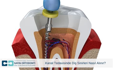 Kanal Tedavisinde Diş Sinirleri Nasıl Alınır Sayın Ortodonti