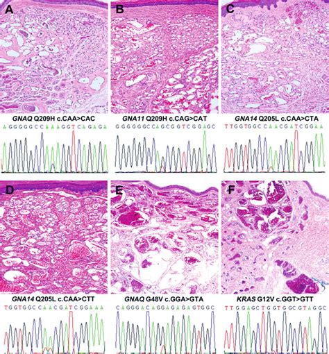 High Frequency Of Gna Gnaq And Gna Mutations In Cherry Hemangioma