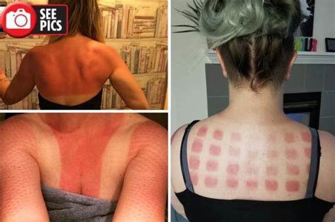 Worst Sunburns Ever Hilarious Snaps Of People With Their Very Awkward