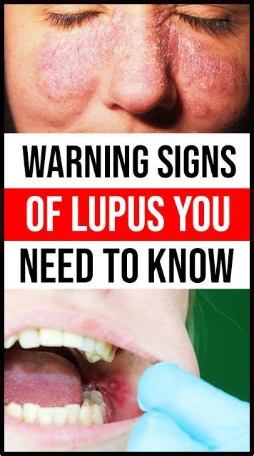 Early Warning Signs Of Lupus You Need To Know And What To Do When You