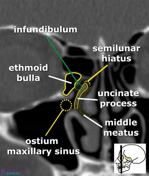 Ct Sinus