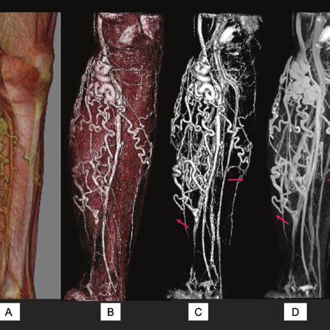 CT Venography And MR Venography For The Varicose Veins The Same