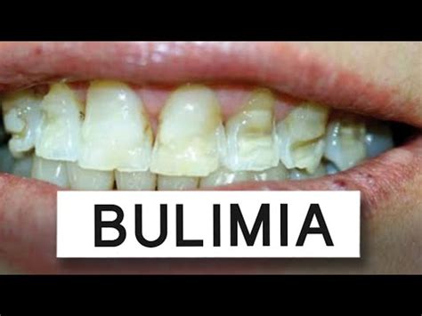 What Bulimia Does To Your Mouth YouTube