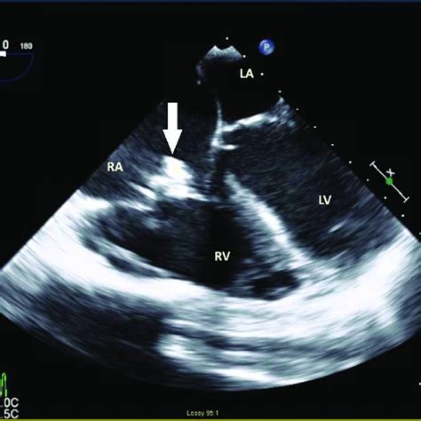 Transthoracic Echocardiogram Tte Showing Tricuspid And Mitral Download Scientific Diagram