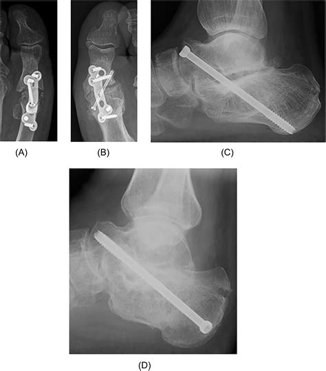 The Effects Of Nsaids On Foot And Ankle Arthrodesis Procedures A