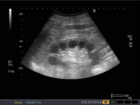 Mild Hydronephrosis Ultrasound