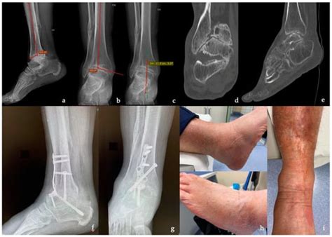 Tibiotalar And Tibiotalocalcaneal Arthrodesis With Paragon