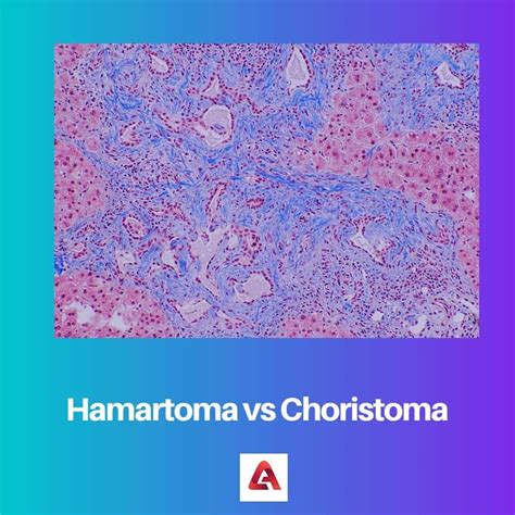 Hamartoma Vs Choristoma Difference And Comparison