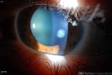 Corneal Scar - Retina Image Bank