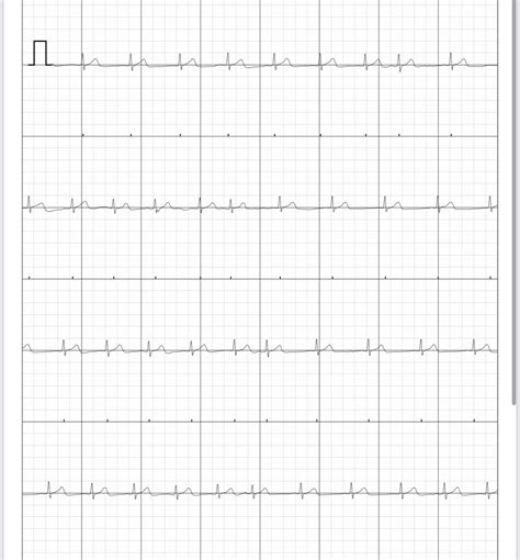 Possible Afib? : r/AFIB