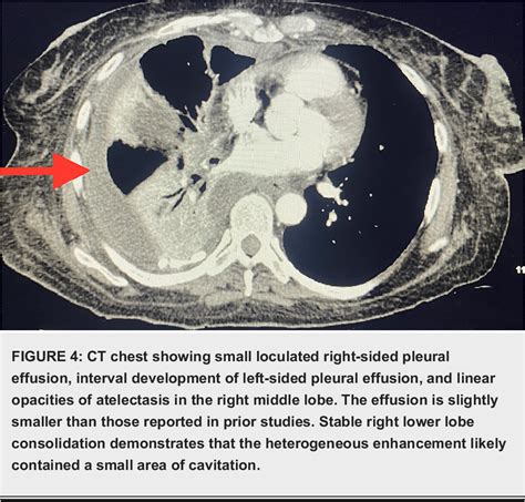 PDF A Case Of Bronchopleural Fistula And Hydropneumothorax In A