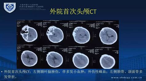 颅脑创伤 神经重症病例周刊（第25期）丨小儿合并严重颌面部外伤的开放性脑外伤治疗一例 搜狐