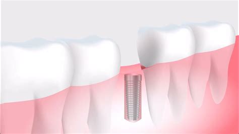 Tooth Implant Surgery Procedure Dental Implant Procedure Youtube