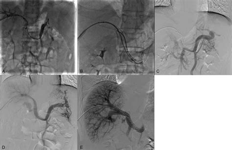 A Portal Venogram Showing Complete Occlusion Of The MPV Trunk And