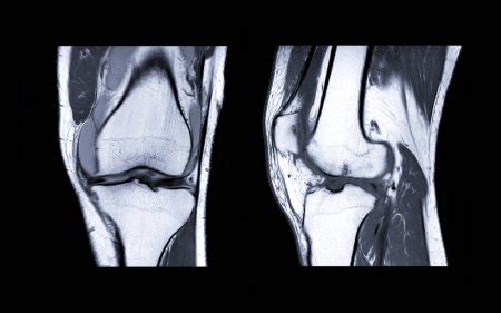 Magnetic Resonance Imaging Mri Knee Joint Axial Coronal View Detect