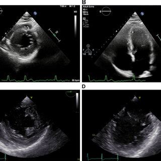 Transthoracic A B And Transesophageal C D Echocardiogram