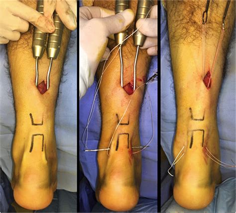 Technique Of Achilles Tendon Repair Intraoperative Image With The