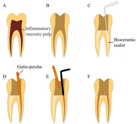 Bioengineering Free Full Text Bioceramics In Endodontics Updates