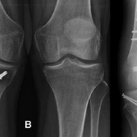 A Preoperative Anteroposterior X Ray View Of A Lateral Tibial Plateau