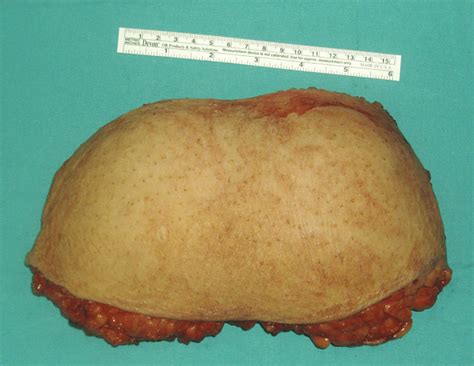 Excised neoplasm with overlaying skin. | Download Scientific Diagram