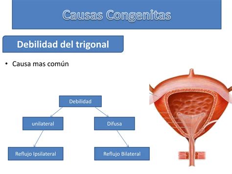 Reflujo Vesico Ureteral Mm Ppt Descarga Gratuita