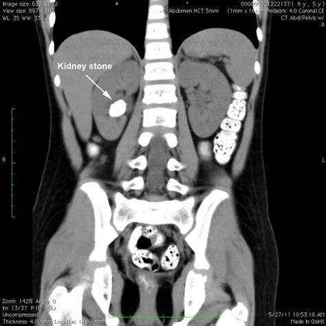 kidney ct scan labeled  isabelle bloch blog