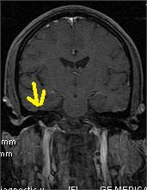 Glomus Tympaniucm-MRI &CT - Sumer's Radiology Blog