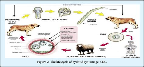 Figure 1 From Role Of Serology And Histopathology In Diagnostic Of Human Cystic Echinococcosis