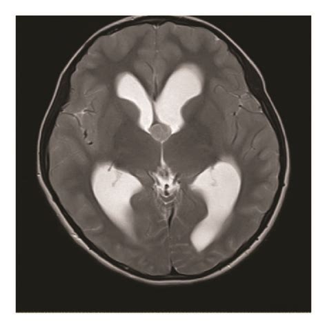 A Nonenhanced Axial Section At The Level Of The Foramen Of Monro A Download Scientific