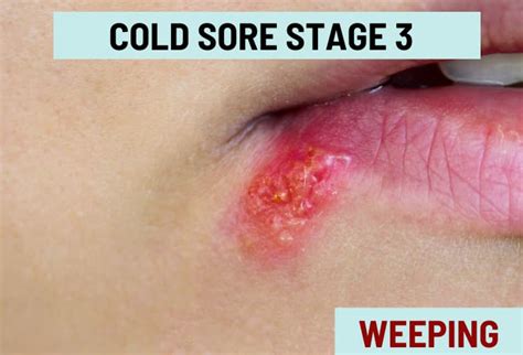 Cold Sores Causes Treatment Fever Blisters Vs Cold Sores 40 Off